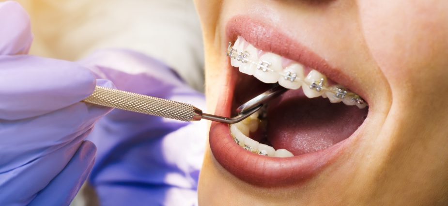 close up view of a smiling woman with braces receiving orthodontic treatment