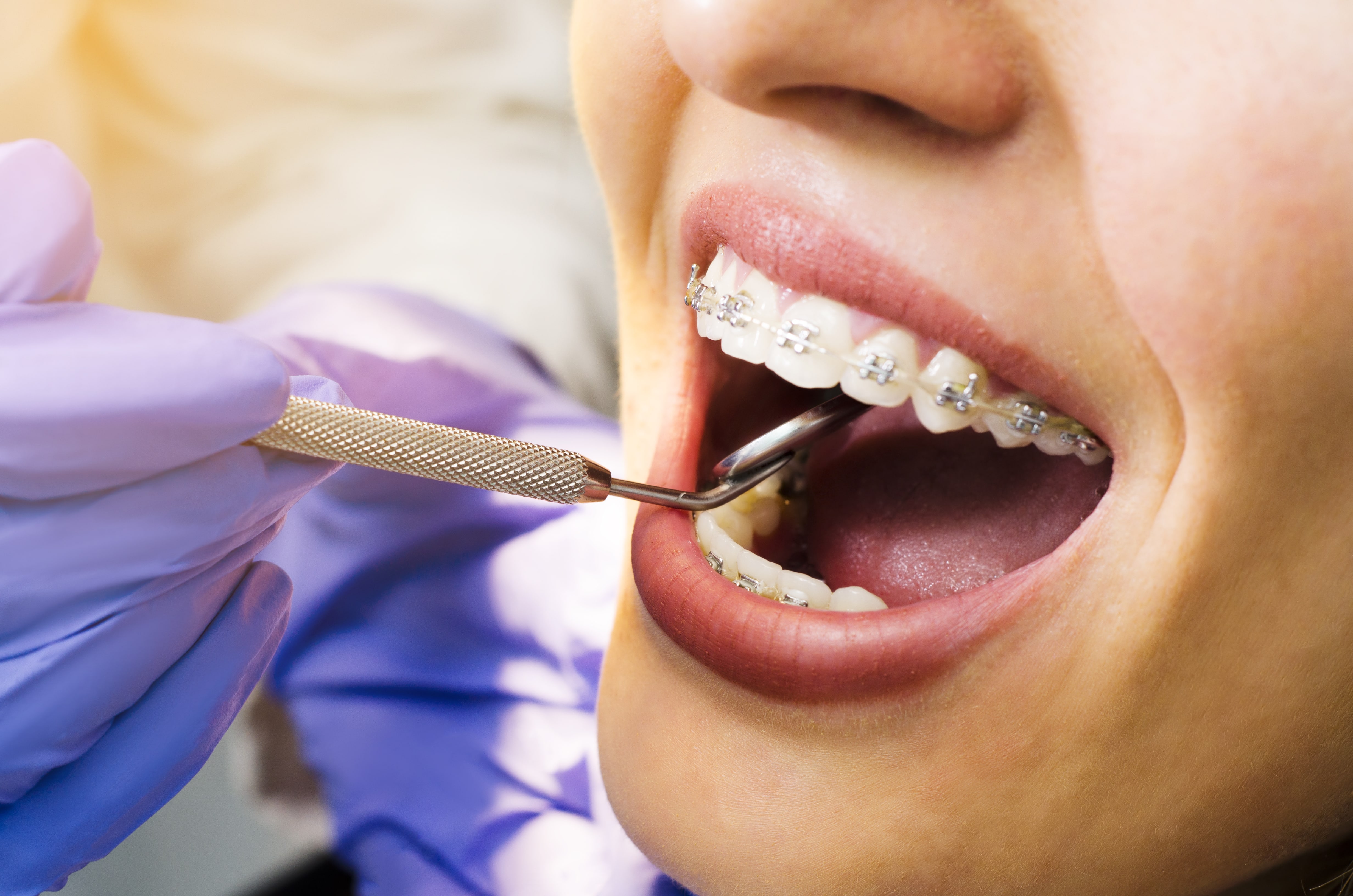 Dental Braces Treatment Details Removal Recovery