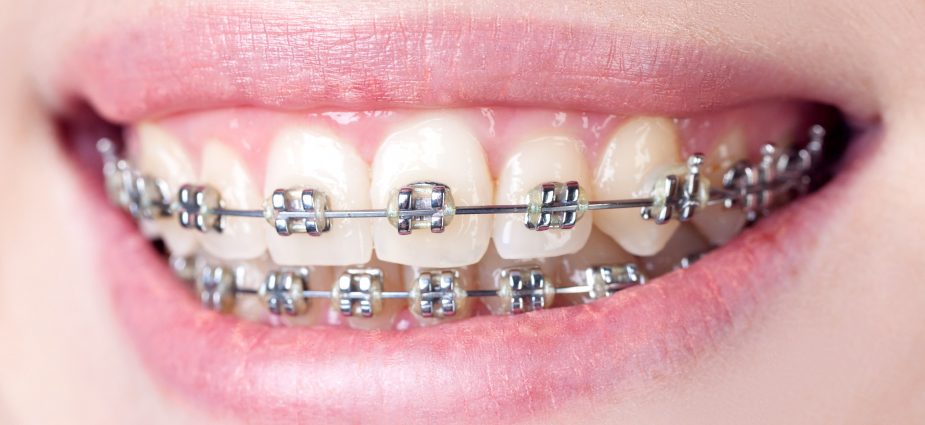 Traditional Dental Braces vs Invisalign Aligners - Consumer Guide to  Dentistry
