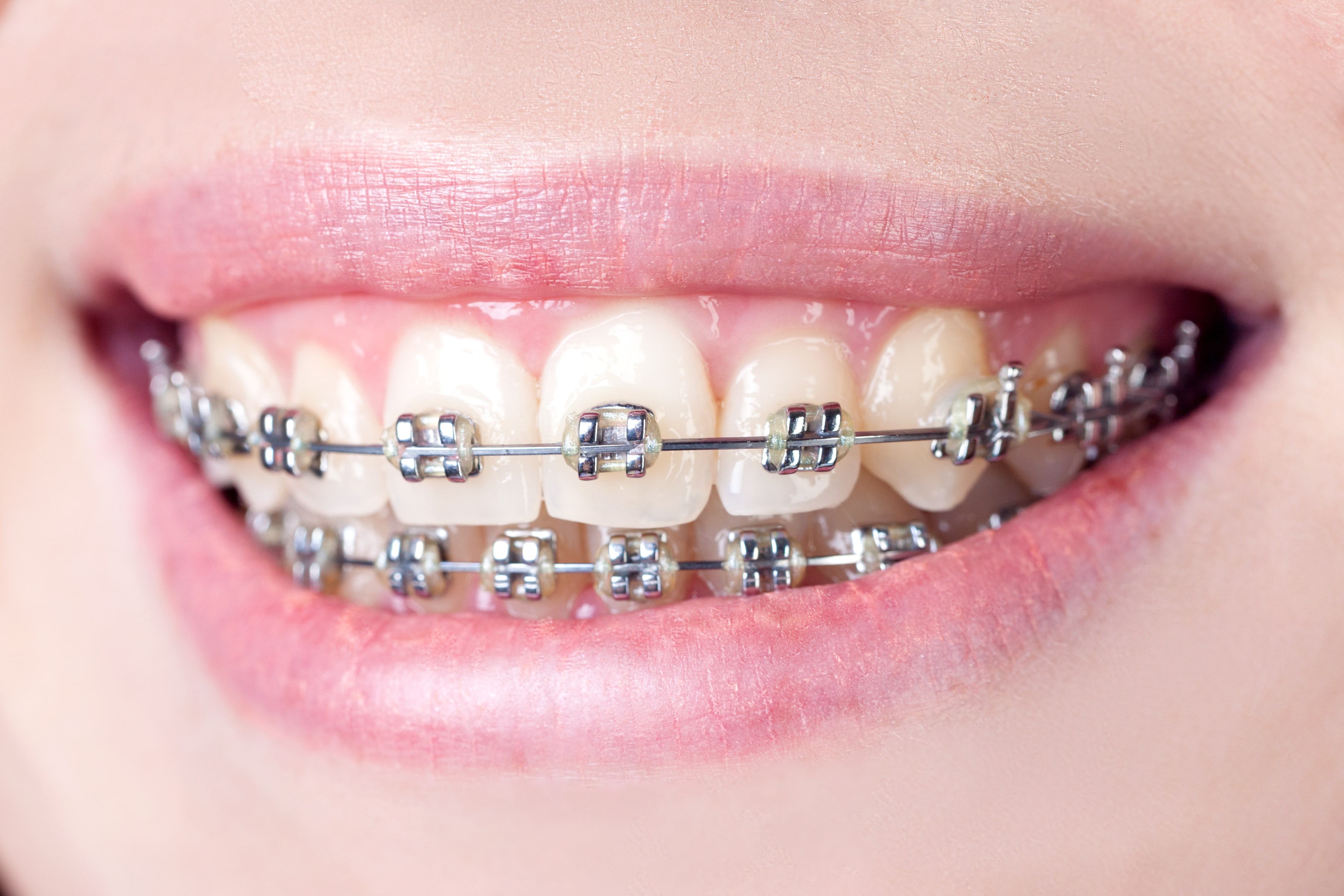 Traditional Dental Braces vs Invisalign Aligners ...