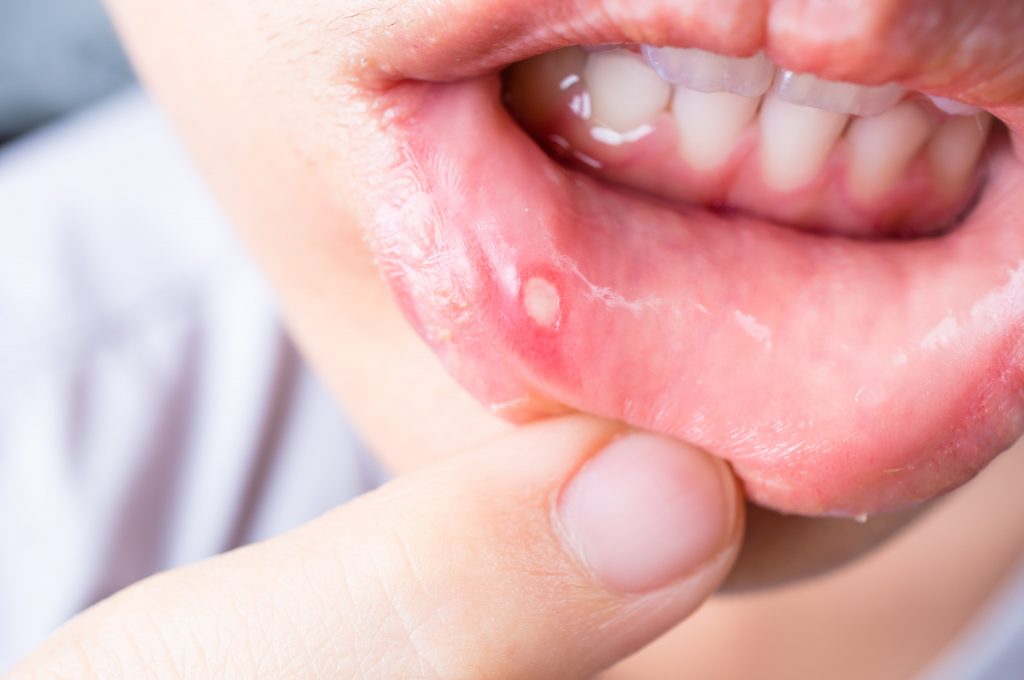 Can Toothbrush Cause Canker Sore 