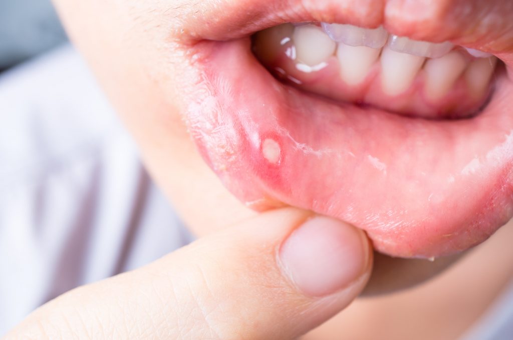 7 Reasons You Keep Getting Canker Sores Consumer Guide To Dentistry