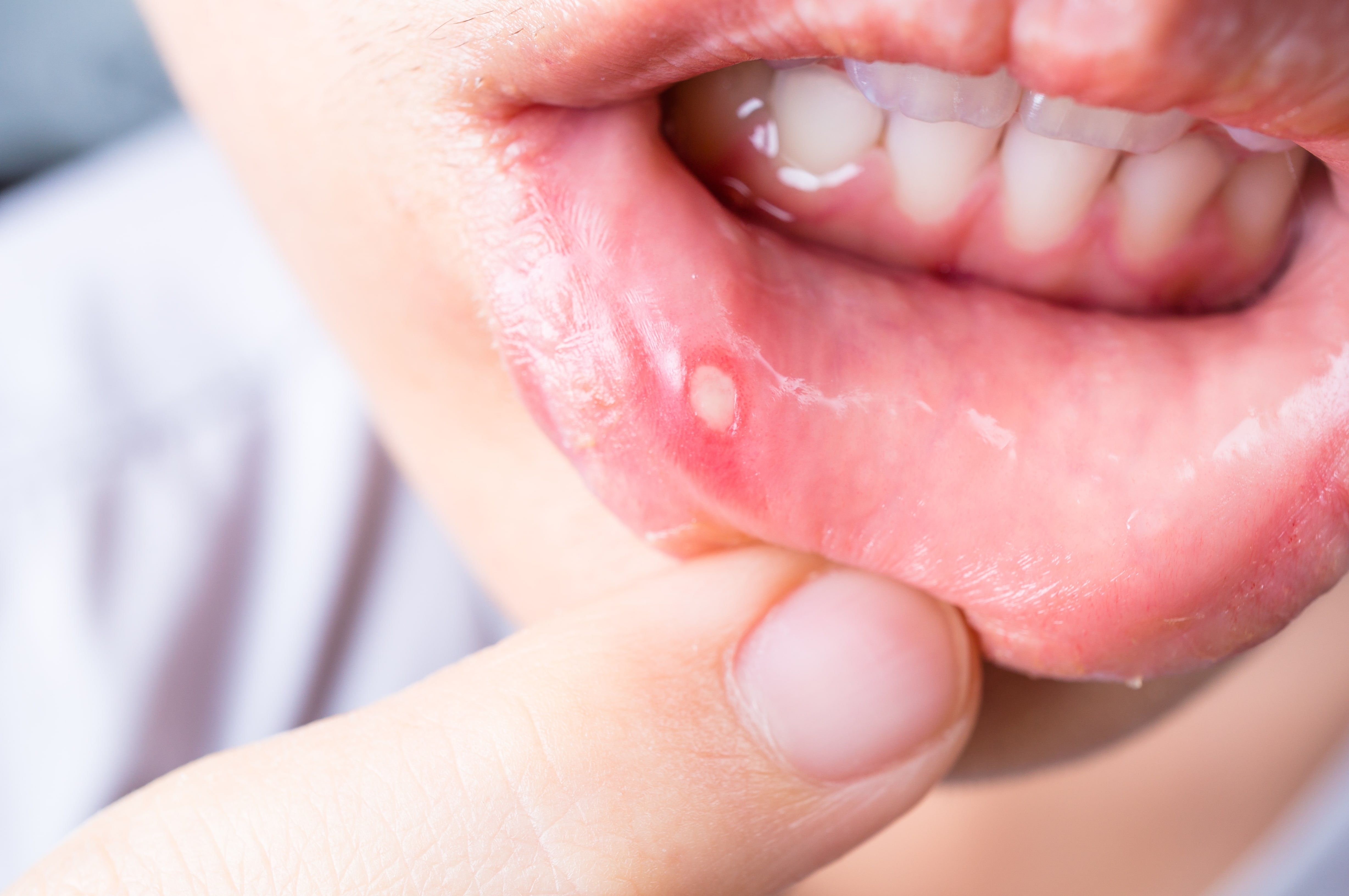 7 Home Remedies for Canker Sores - Consumer Guide to Dentistry