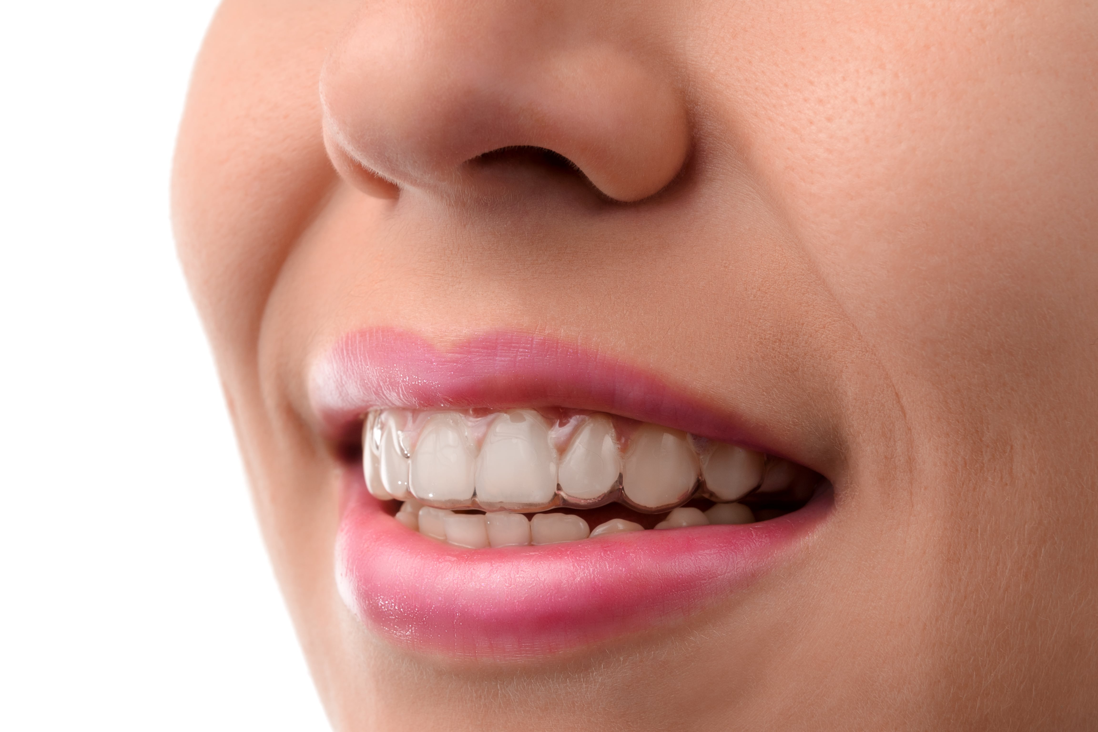 Invisalign Express & Teen  A Better Orthodontic Option?