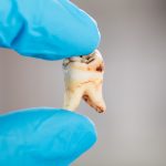 close up photo of a dentist holding an extracted, decayed tooth