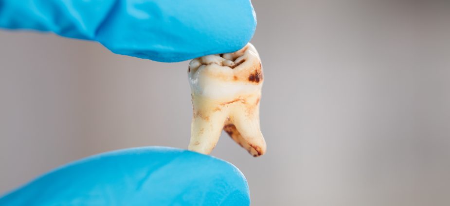 close up photo of a dentist holding an extracted, decayed tooth