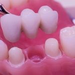 close up of a dental bridge showing preparation of adjacent teeth