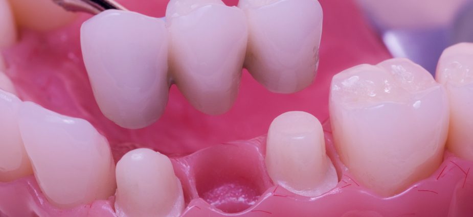 close up of a dental bridge showing preparation of adjacent teeth