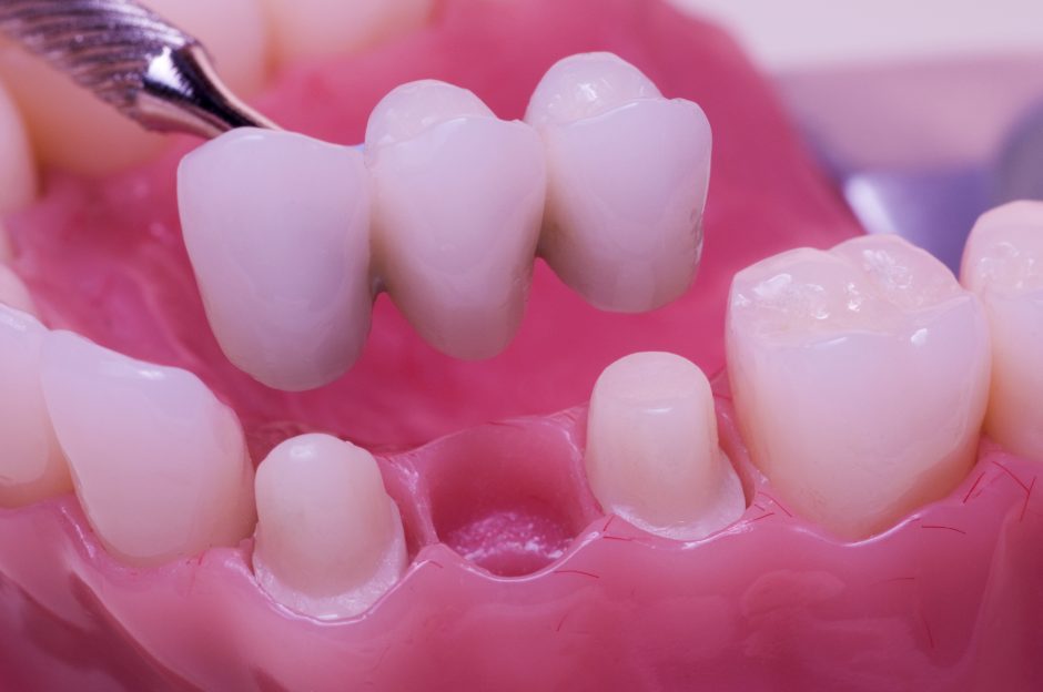 Puentes Dentales Como Funcionan Y Cuanto Cuestan