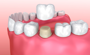 illustration showing a dental crown being placed on an abutment to replace a missing tooth