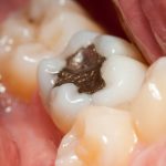 close up of a row of teeth and a dental amalgam filling