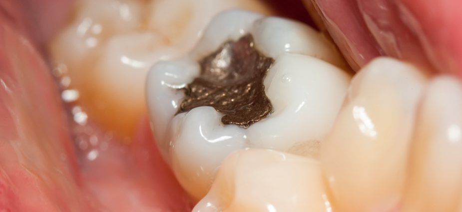 close up of a row of teeth and a dental amalgam filling