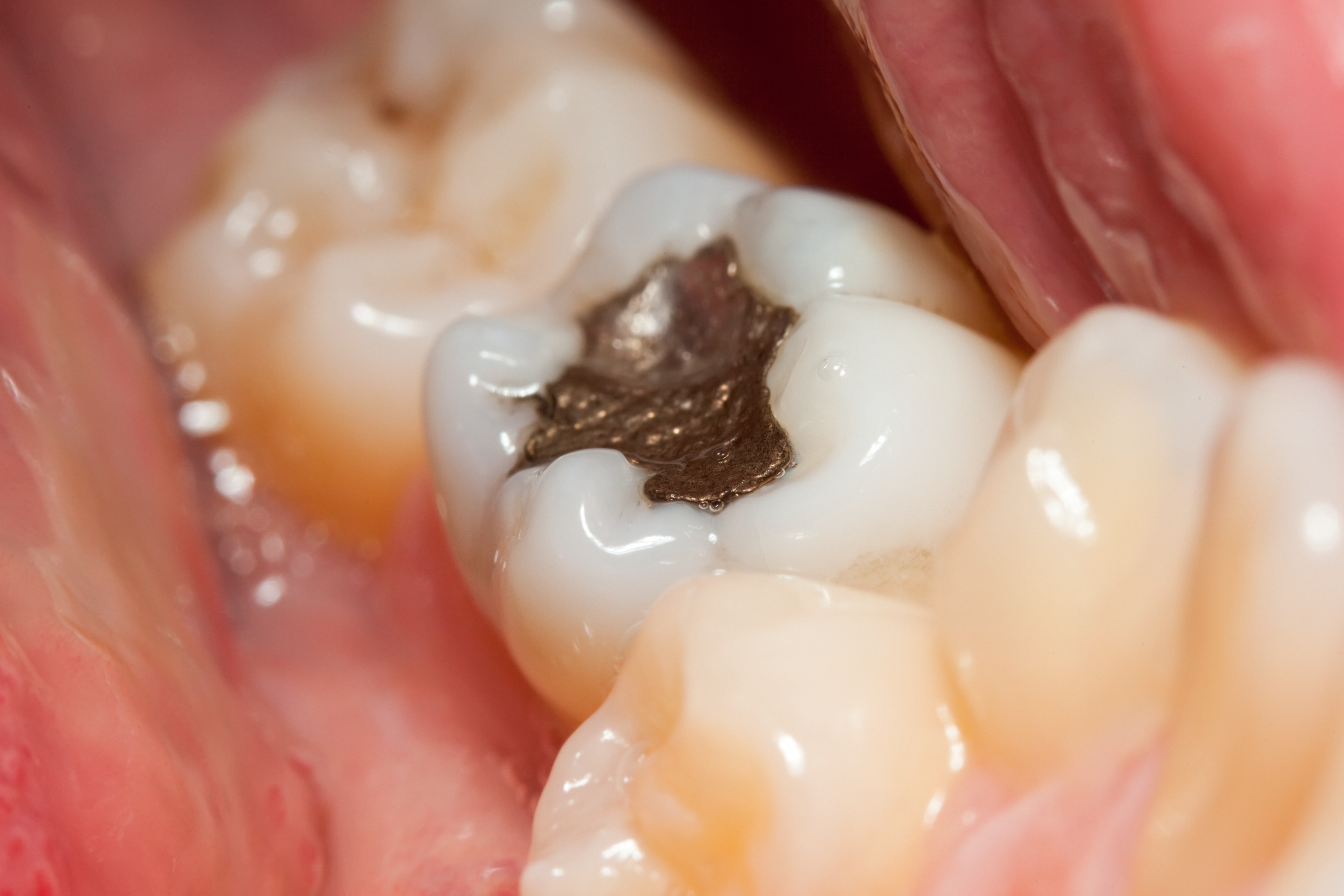 What is a Cavity Filling? - Keep 28 Dental