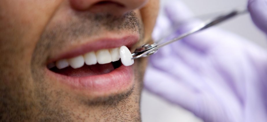 Sabe cómo se colocan las carillas dentales sin desgaste? - Estética dental