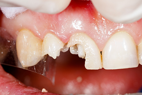 Seven Toothache Causes &amp; Solutions - YourDentistryGuide.com