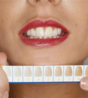زنی که دندانهای خود را در کنار راهنمای سایه سفید کننده دندان نشان می دهد