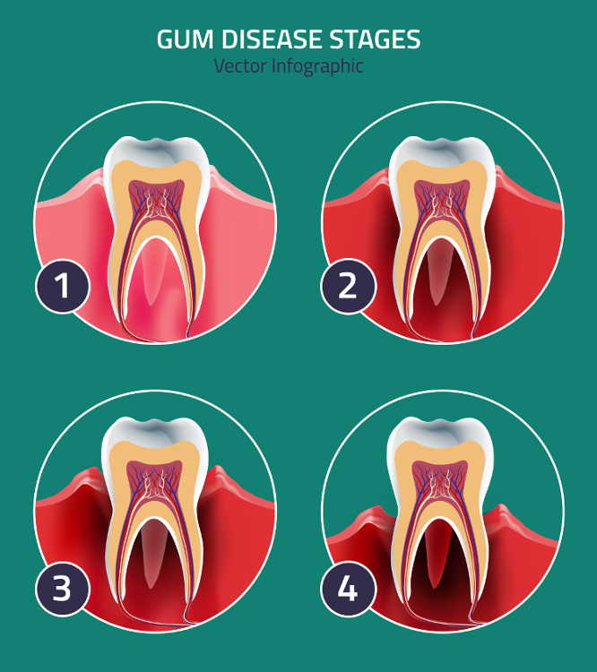 World Dental Federation Targeting Spread of Gum Disease