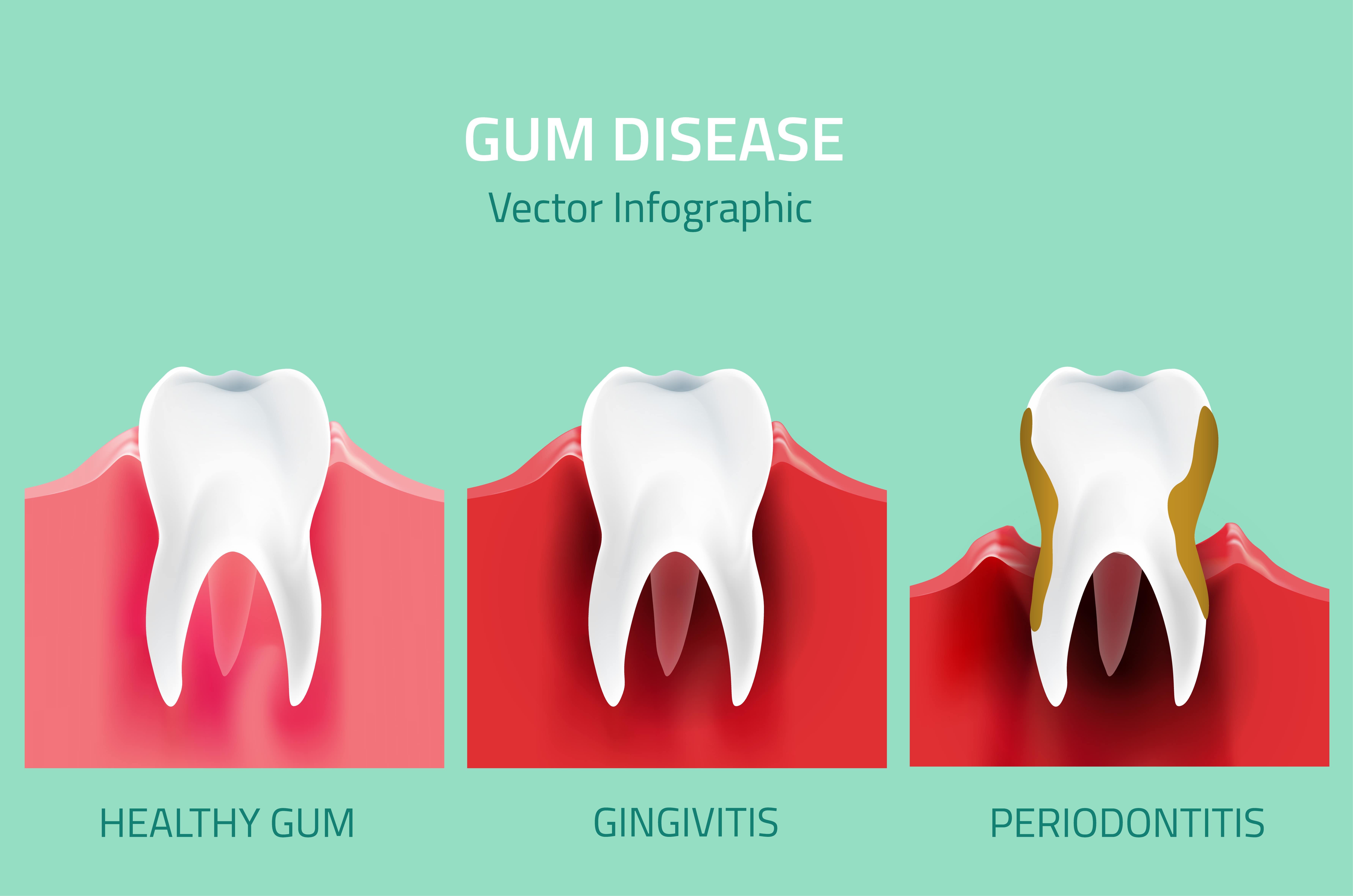 Gum Disease Signs Symptoms And Treatment Options