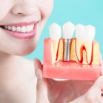 smiling woman holding a model of a row of teeth with a dental implant