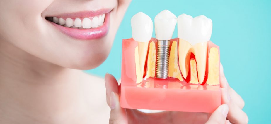 uśmiechnięta kobieta trzymająca model rzędu zębów z implantem dentystycznym