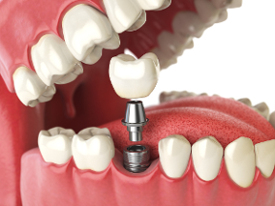 illustration showing how a dental implant is attached to an abutment and dental crown