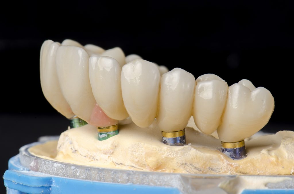 Implantsupported Full Arch Restorations Allon4, Teeth Tomorrow and More