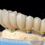 model showing a full lower arch with dental implants