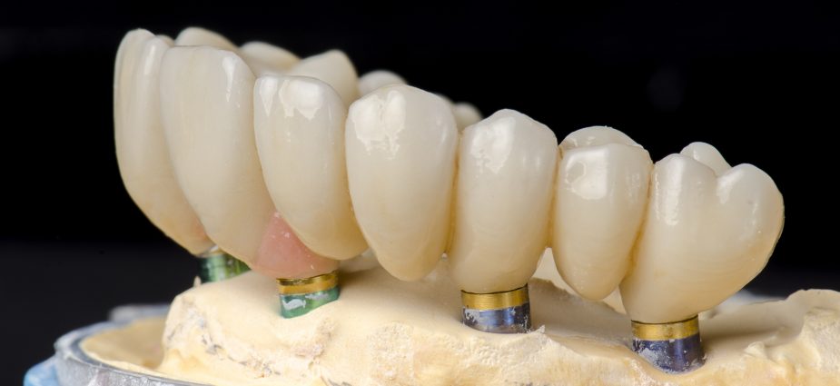 model showing a full lower arch with dental implants