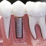 model showing a comparison between natural teeth roots and a dental implant above and below the gumline