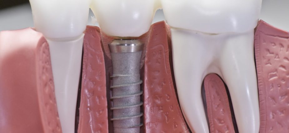 https://www.yourdentistryguide.com/wp-content/uploads/2017/11/implants-vs-min-925x425.jpg