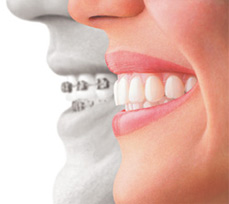 side by side comparison showing traditional dental braces and a clear dental aligner