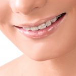 close up of a smiling adult woman wearing clear dental braces