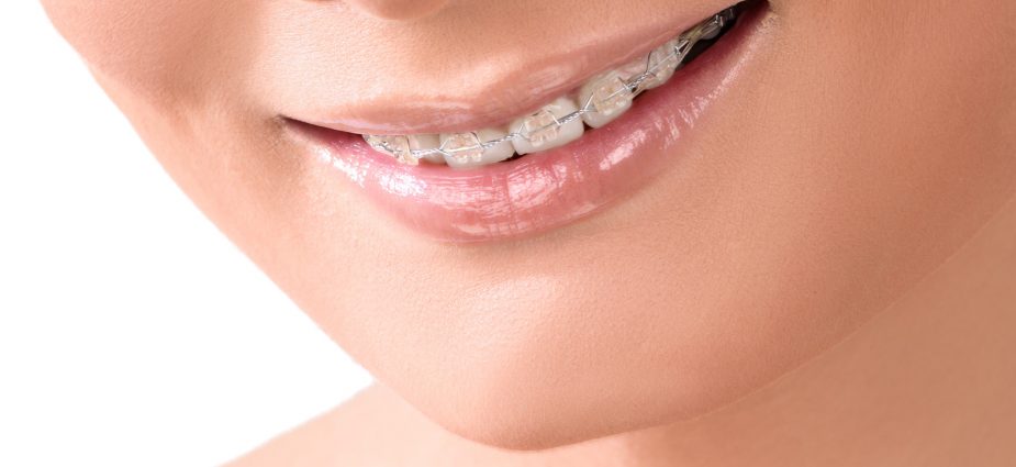 Cerca de una mujer adulta sonriente que lleva aparatos dentales transparentes