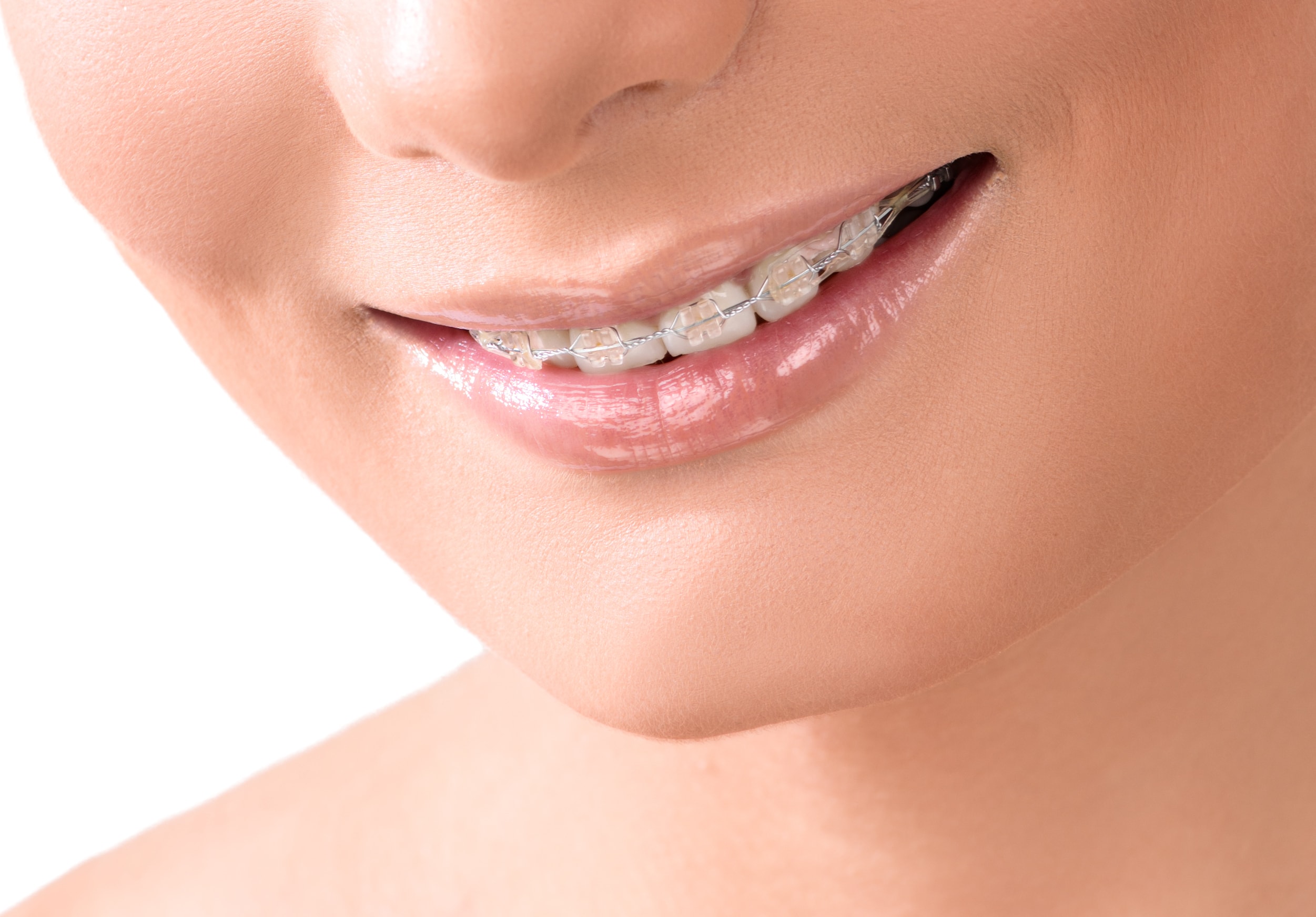 invisible Orthodontic Treatment (Braces)