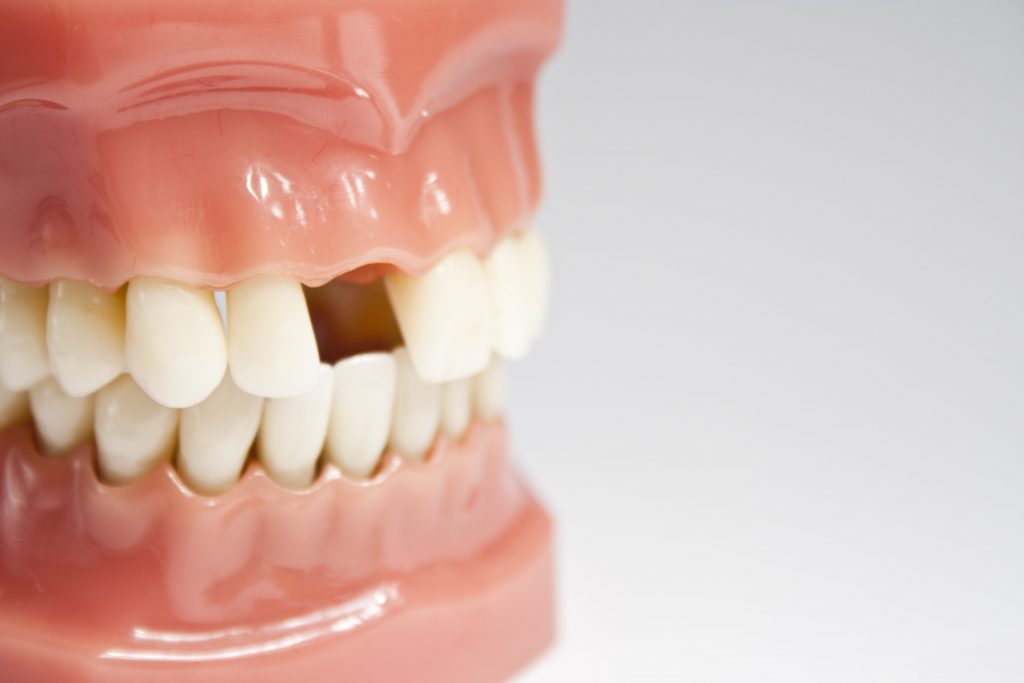 6 Dental Effects of Missing a Tooth | Consumer Guide to Dentistry