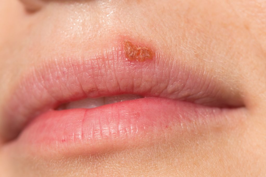 Oral Herpes Symptom