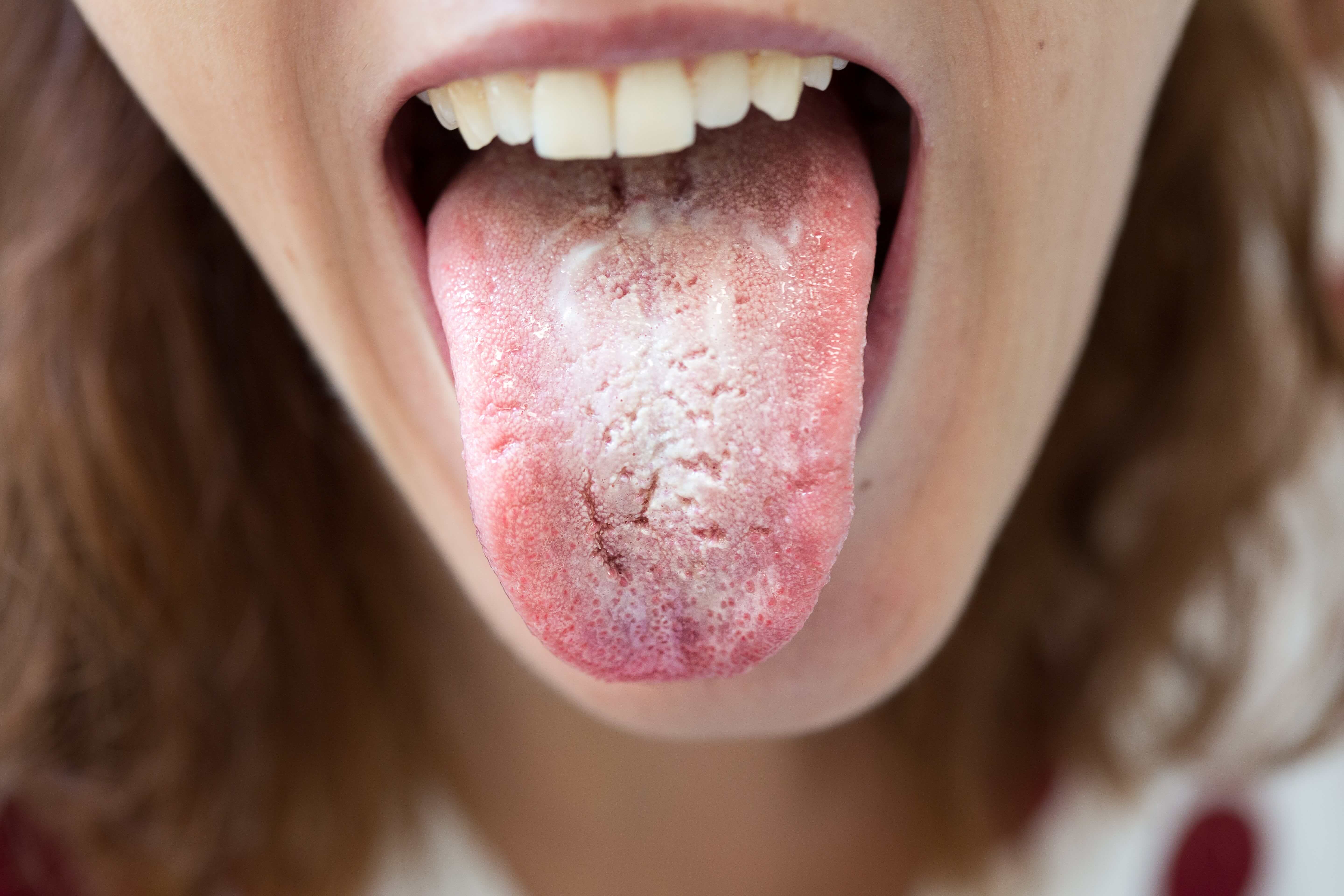 Candidiasis Oral Thrush 93