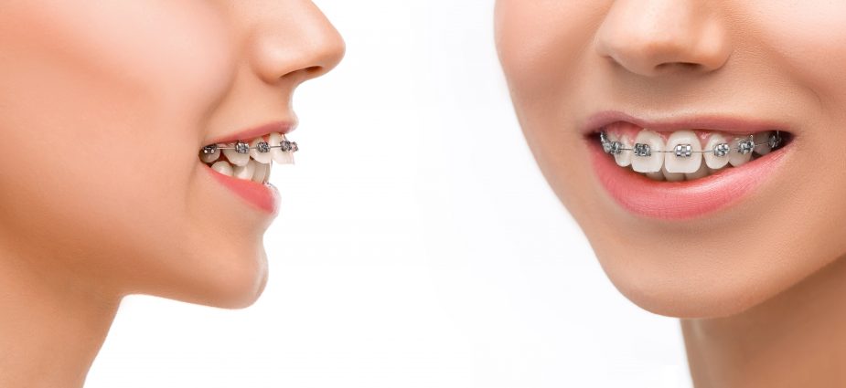 Dental Solutions for Overbite, Underbite, Crooked & Crowded Teeth