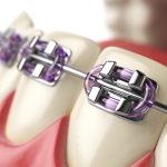 illustrated close up of dental braces fitted on teeth