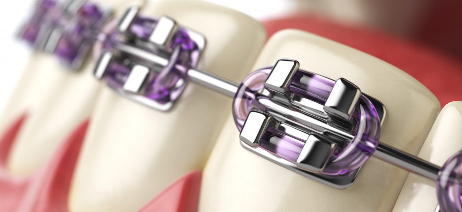 illustrated close up of dental braces fitted on teeth