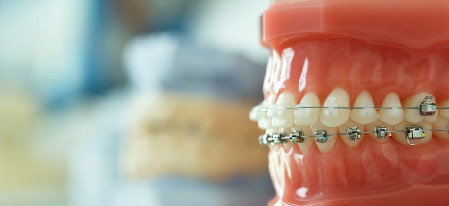 close up shot of a model of teeth displaying dental braces