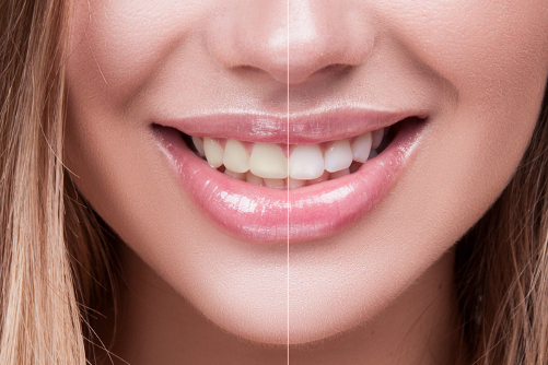 6 Most Common Treatments to Enhance Your Smile