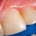 close up view of stained, discolored teeth