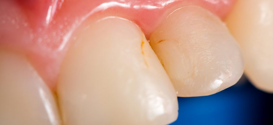 close up view of stained, discolored teeth