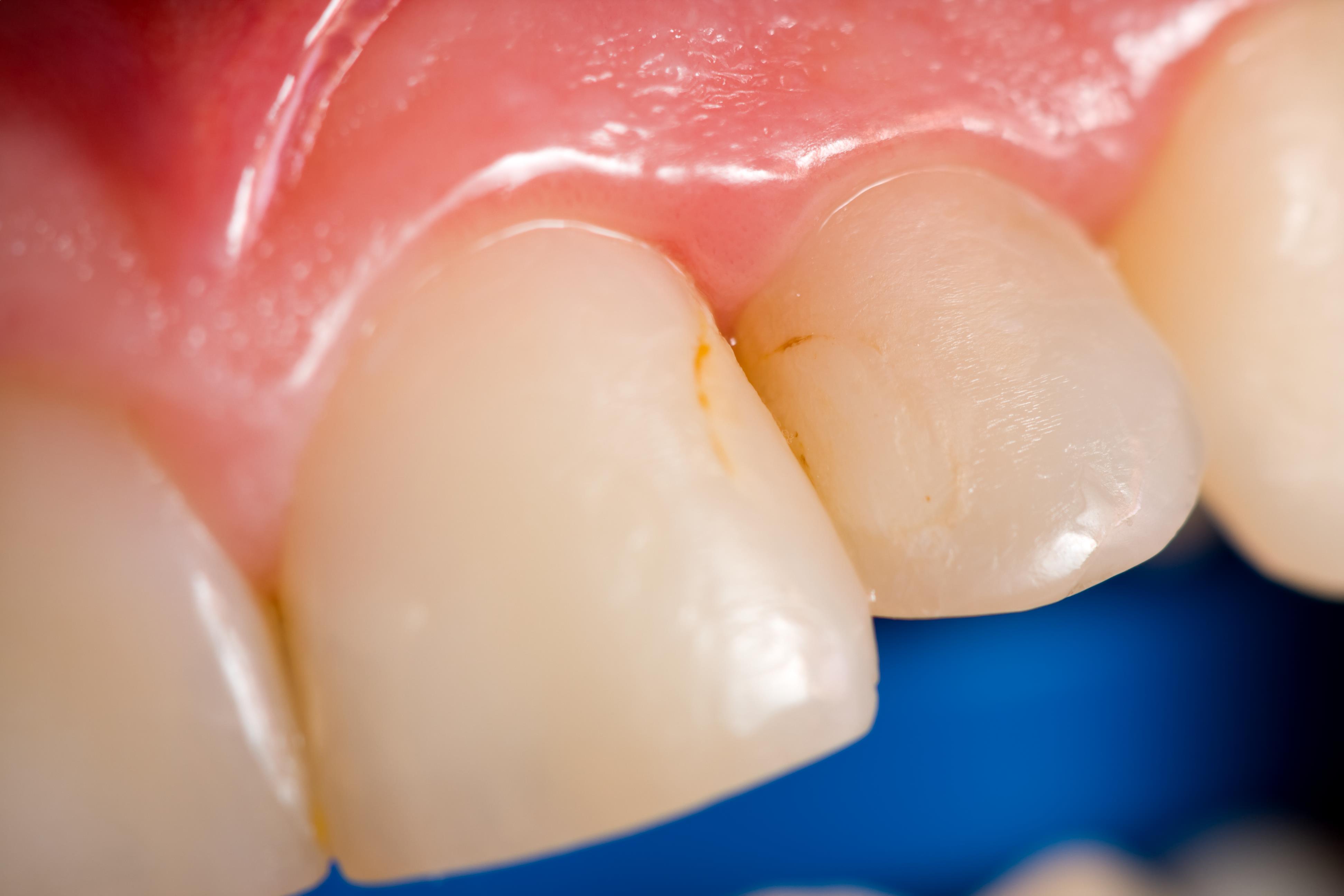 Tooth Discoloration | What's Behind Stained and Yellow Teeth?