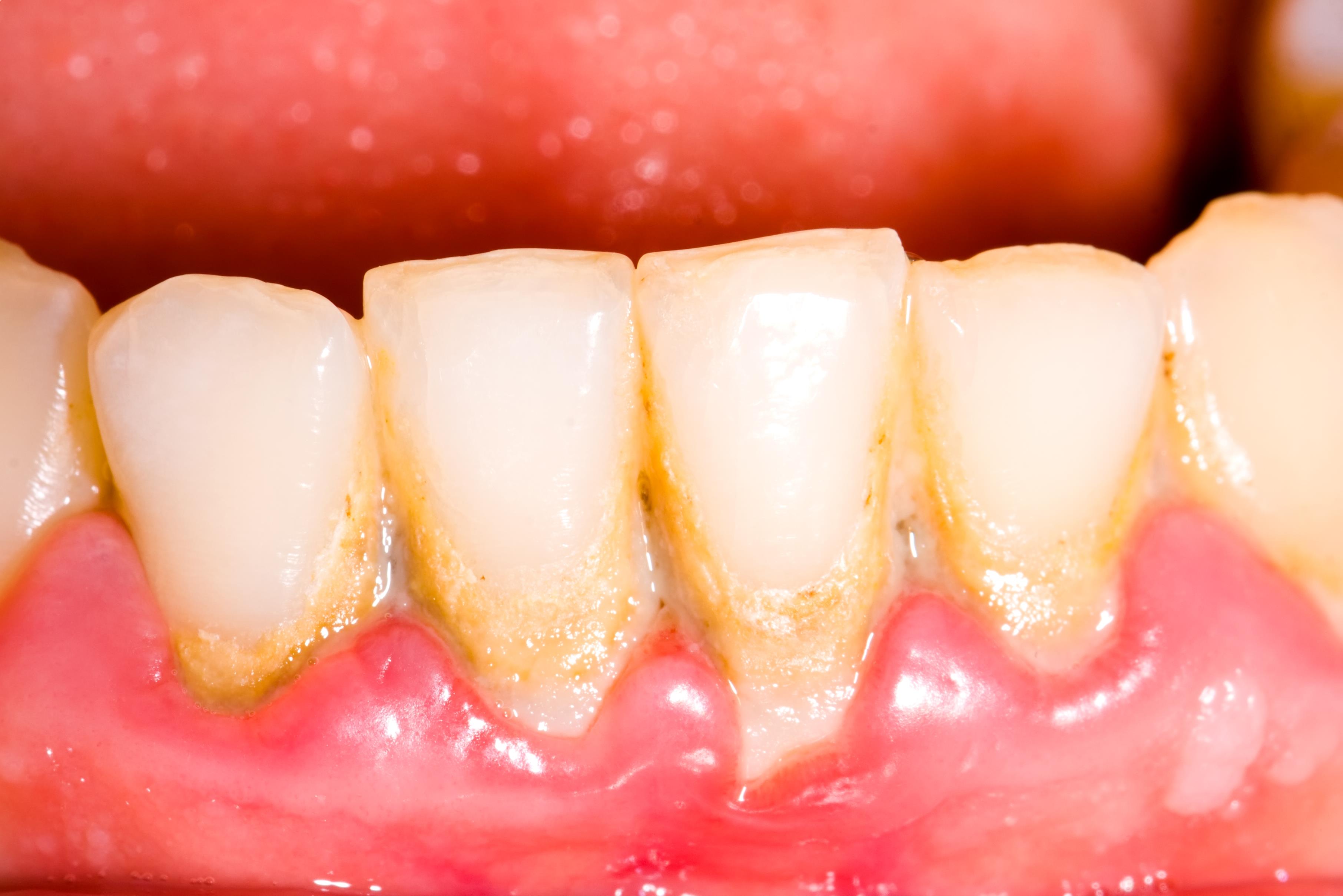 Dental Plaque | What Problems Can it Lead to?