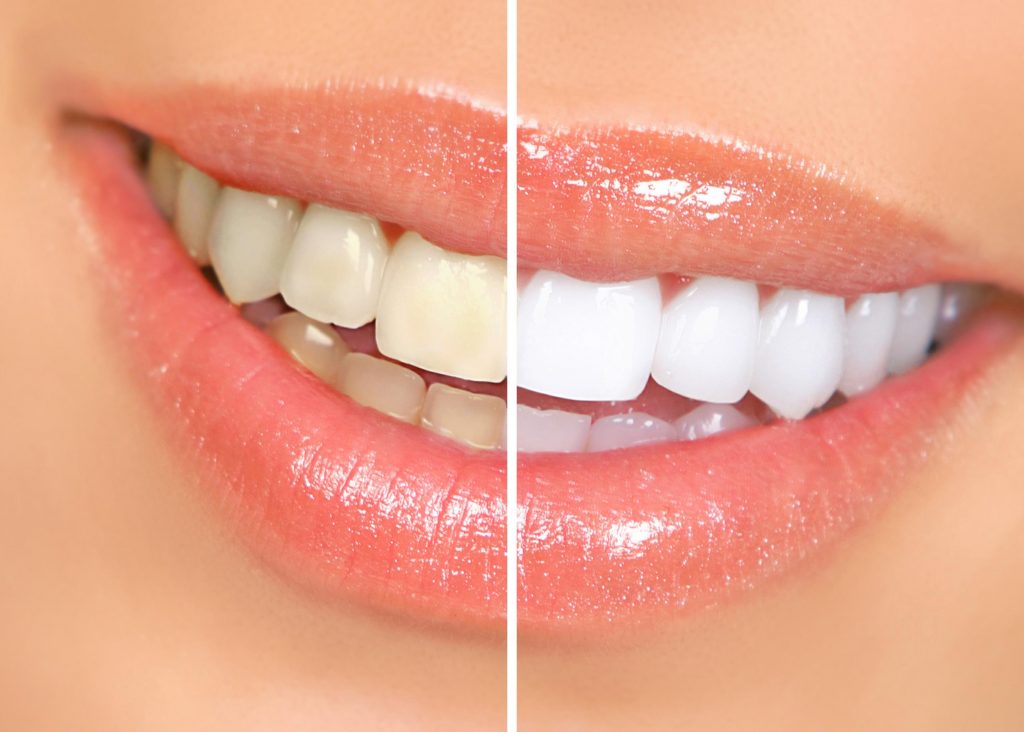 7 Tips for White Teeth - Consumer Guide to Dentistry