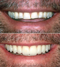 male dental patient smiling before and after smile makeover