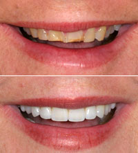 female dental patient smiling before and after smile makeover