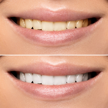 نزدیک از یک زن خندان قبل و بعد از سفید کردن دندان